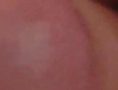 Immense Phimosis Being Extracted Cum and Précum.