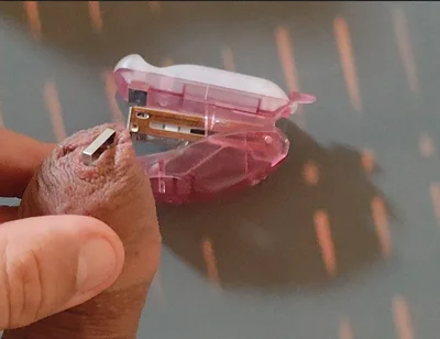 Intense Pleasure Stapling Phimosis