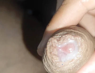 I Have the Largest Ejaculating Phimosis in the World!!