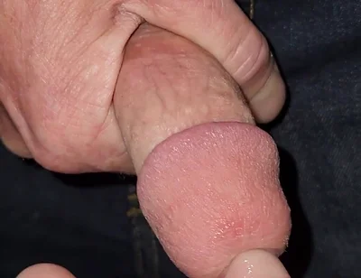 Gaping Urethra - Marker and Pinky Insertion