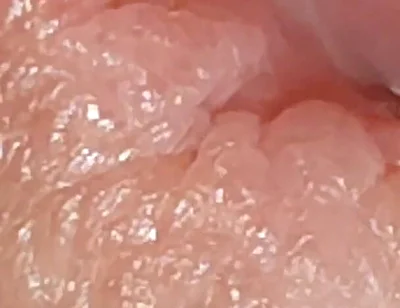 Enlargement of the Deep Urethral Hole!!