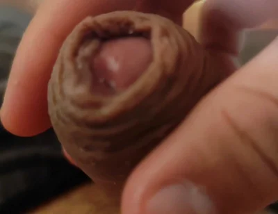 Great Phimosis Getting in the Way of the Boy's Orgasm