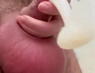 Inflated Ball Sack with Saline