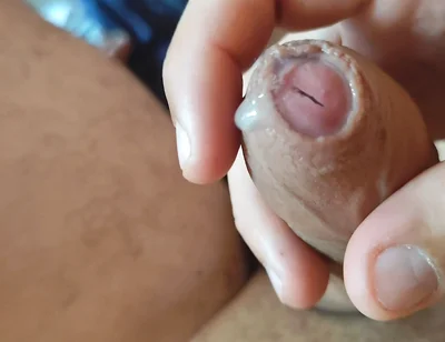 Dilation of the Corpus Cavernosum Exposes Spongy Foreskin.