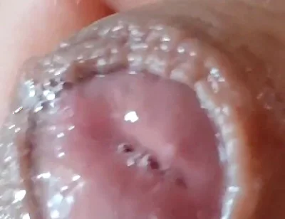 Deep Split in the Glans Produces Bubbling Liquid