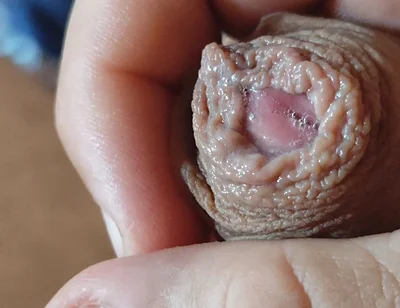 Deep Split in the Glans Produces Bubbling Liquid