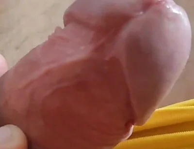 Scarred Frenulum Causes Glans Erection!