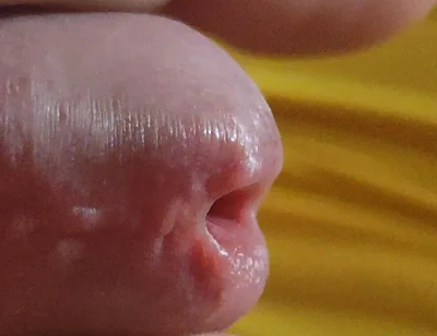 Scarred Frenulum Causes Glans Erection!