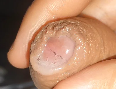 Curious Close-up of Pre-cum in Flaccid Phimosis.