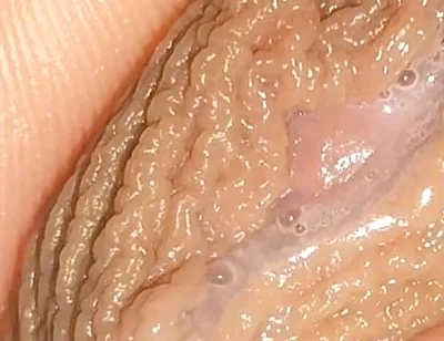 Curious Close-up of Pre-cum in Flaccid Phimosis.