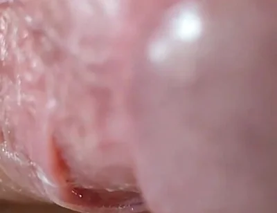 Opening the Scar of the Rough Frenulum!
