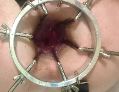 Enema, Anal Shower. Close-up View Through Anal Mirror. Anal with Water. Filling Anal with Water