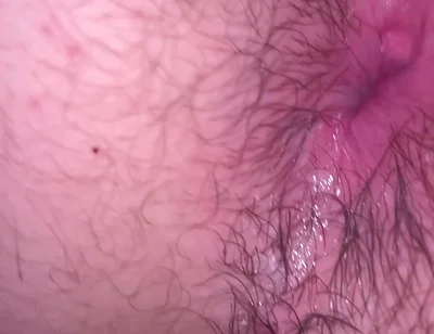 Bruised Asshole