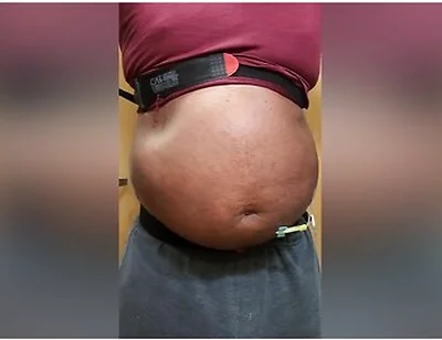 N2o Belly Inflation