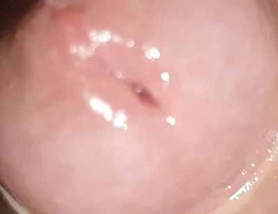 Maximum Dilation of Phimosis Cumming.