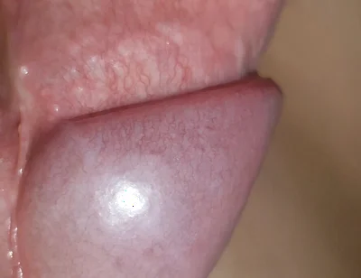 Amazing Upright Rough Venous Frenulum