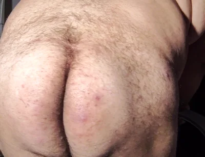 Fat Obese Butt