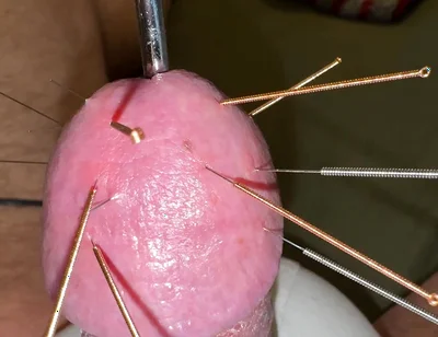 Acupuncture - Orgasm!