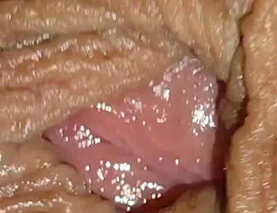 Boy with Large Anal Phimosis Excited!