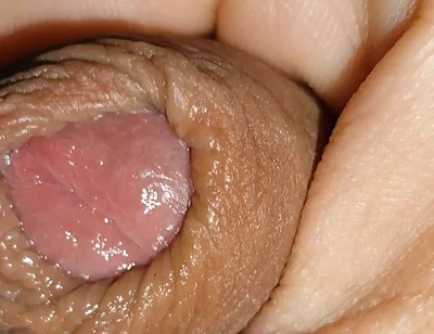 Boy with Large Anal Phimosis Excited!