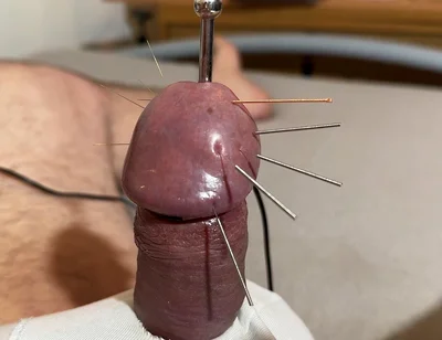 The Best Acupuncture Method!