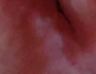 Dilation of the Glans Eye Has a Pleasant Surprise.