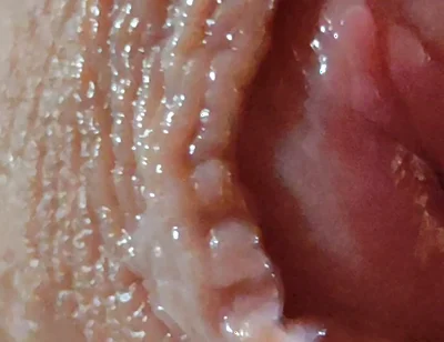 Dilation of the Glans Eye Has a Pleasant Surprise.