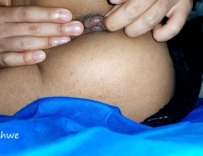 Hemorrhoids in the Ass