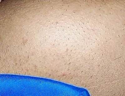 Hemorrhoids in the Ass