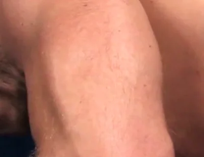 Rugburn