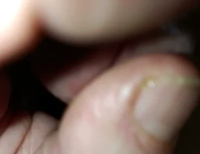Is My Meatus Open?