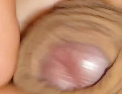 The World's Largest Foreskin Opening and Closing.