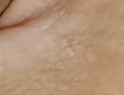 Amazing Dilator Vessel Has Disproportionate Increase.