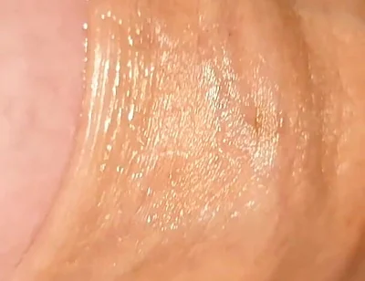 Difficult Fluid Control Due to Straight Phimosis.